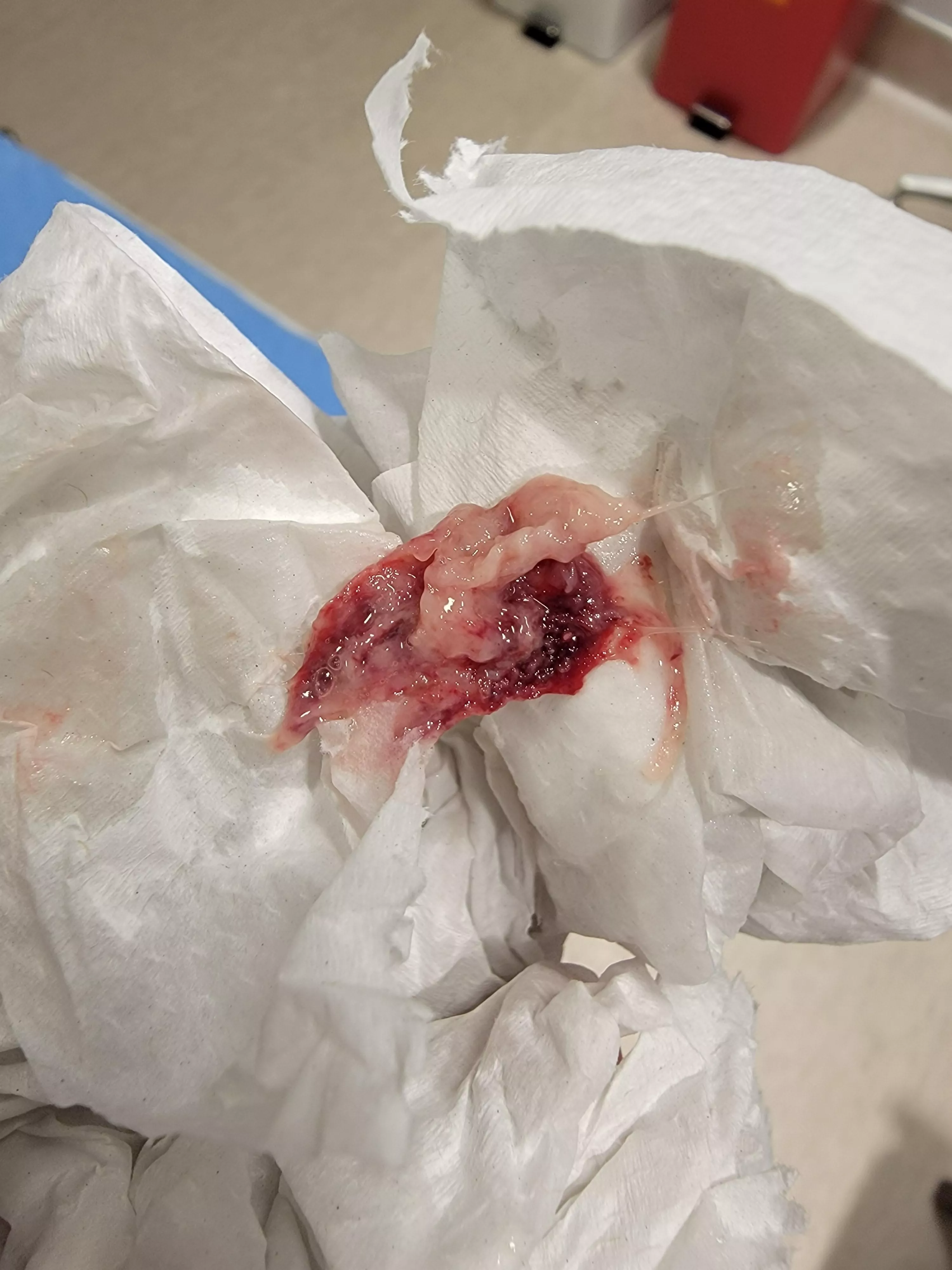 This came out of my nose. My eyeball and face felt great after it left 😌. Possible sinus infection. Posted here because Google lead me to this reddit