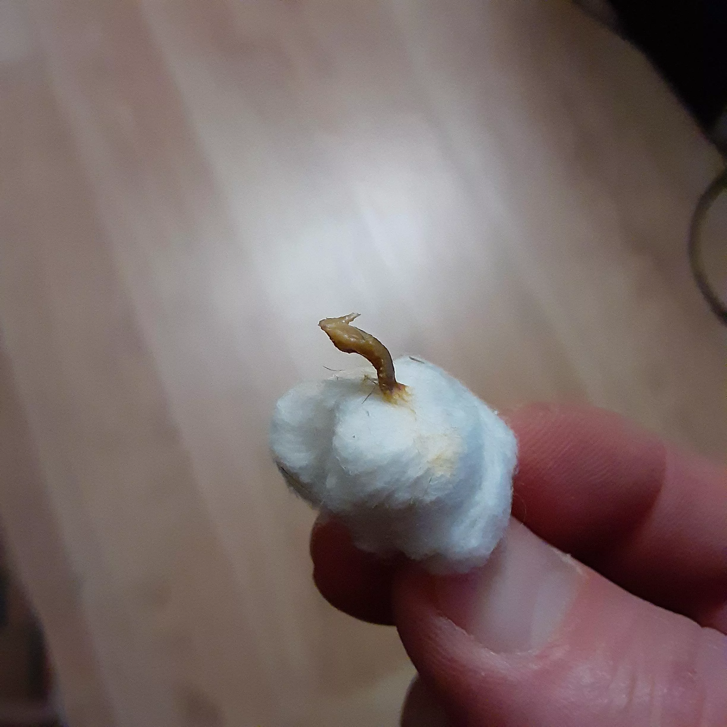 This guy was stuck in the attic of my mastoid cavity.