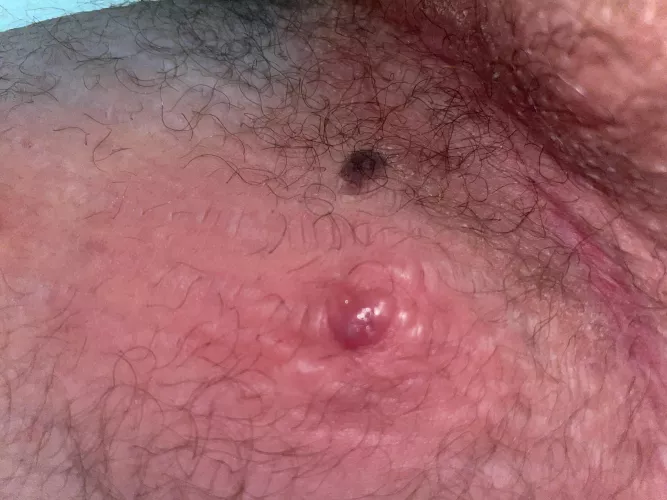 This little bastard popped up on my thigh yesterday, cyst I guess?
