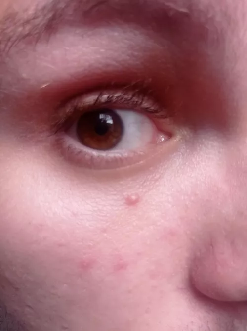 This little guy appeared on my face yesterday. Should I try to burst it with a needle? It seems like a little milia