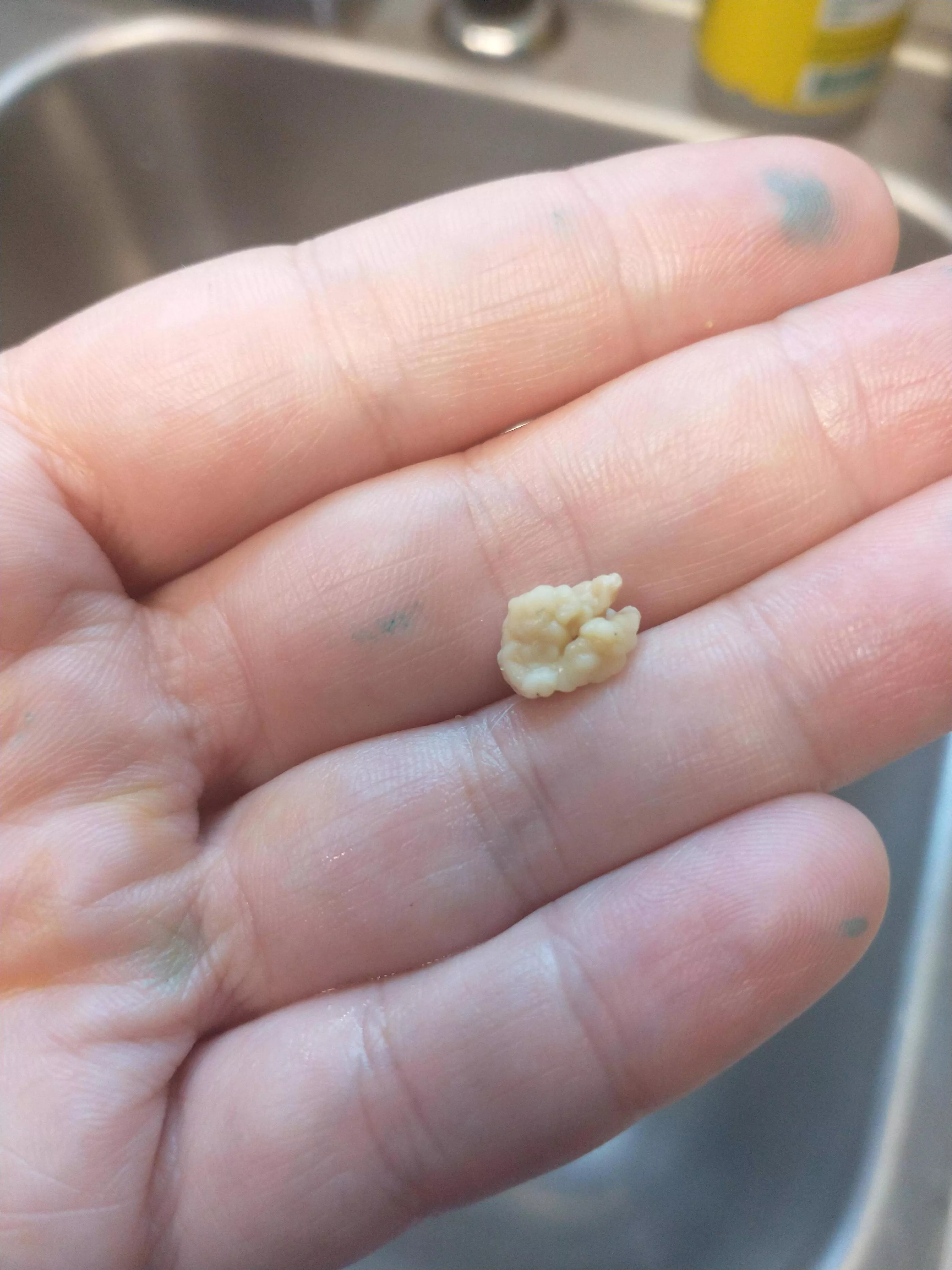 Tonsillectomy scheduled for next week!