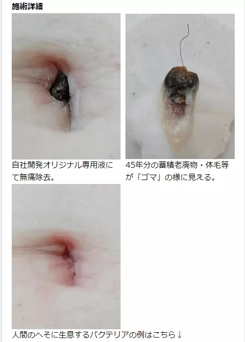 Umbolith Removal - Before and After Photos!