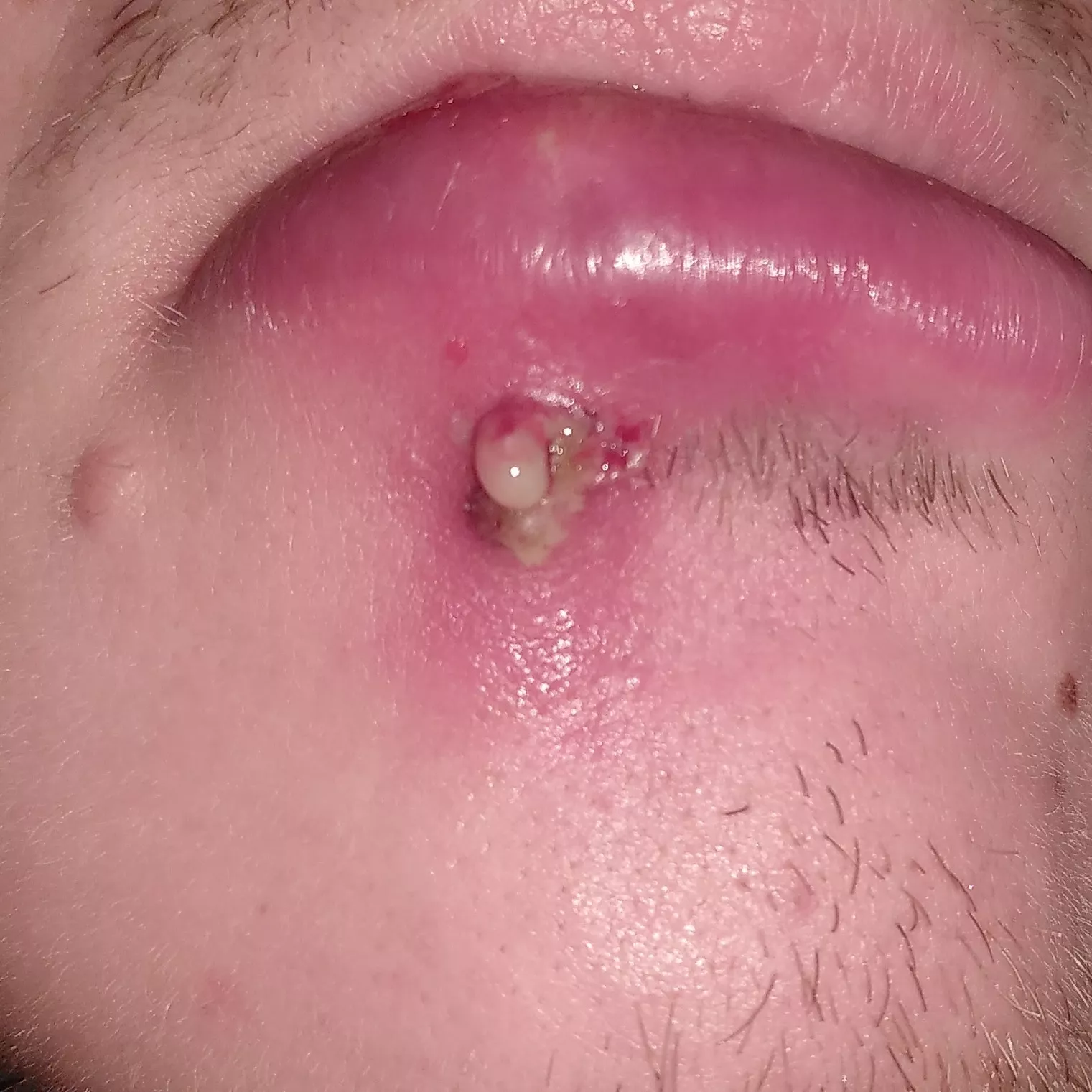 Update: ok people, I habe some relief from pressure, it decided to pop itself