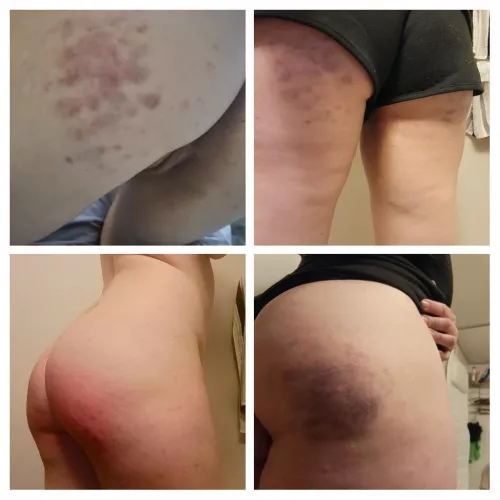 Was left with wonderful marks after a weekend trip 😌