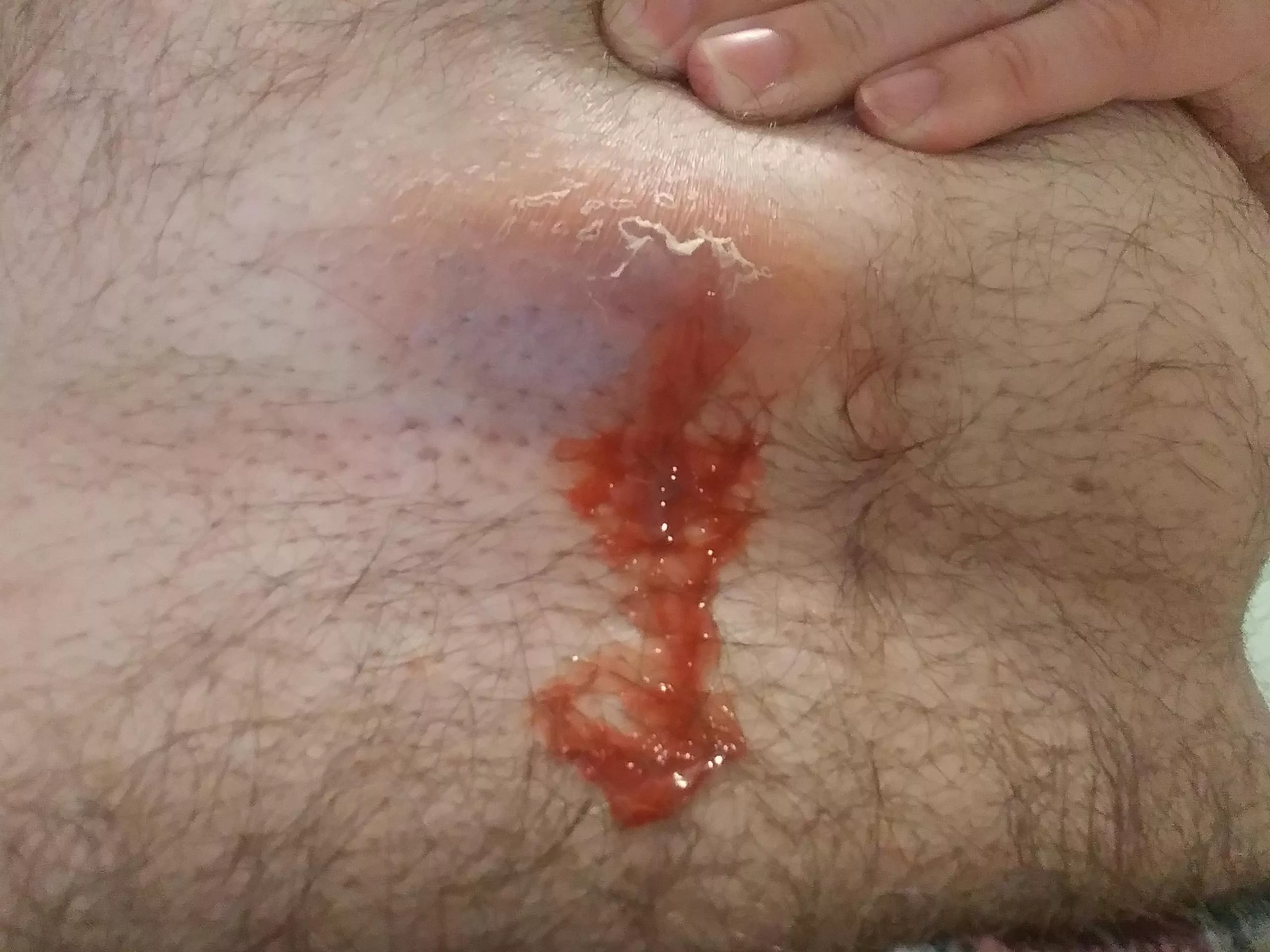 Week Old Abscess Starting to Drain - Presc Antibiotic