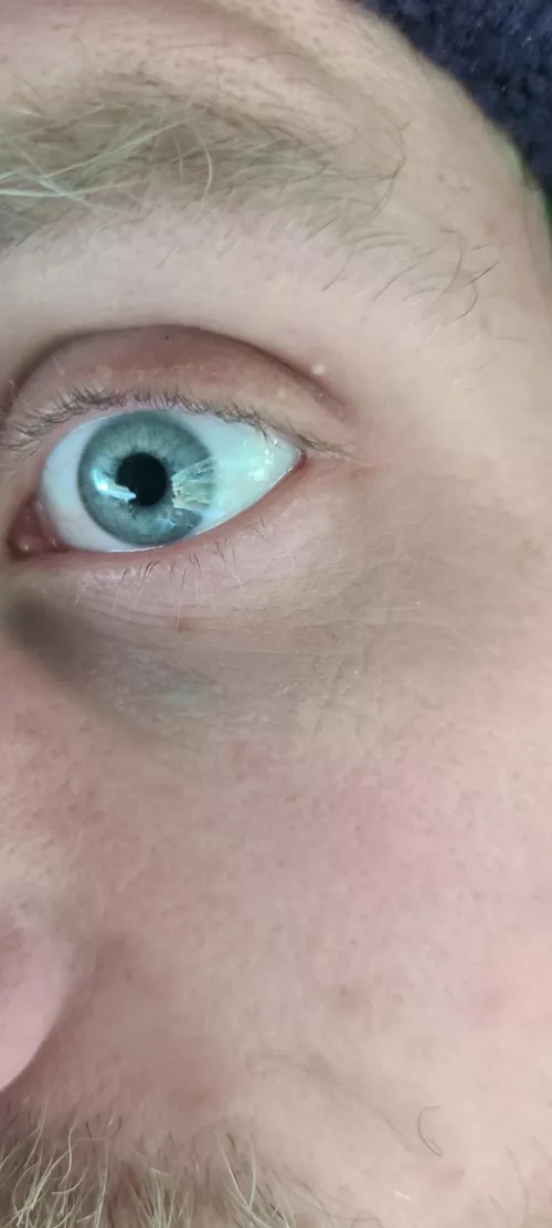 What are these things on my eyelids? They don't pop and aren't sore or anything. Had them for a year or so, maybe longer.