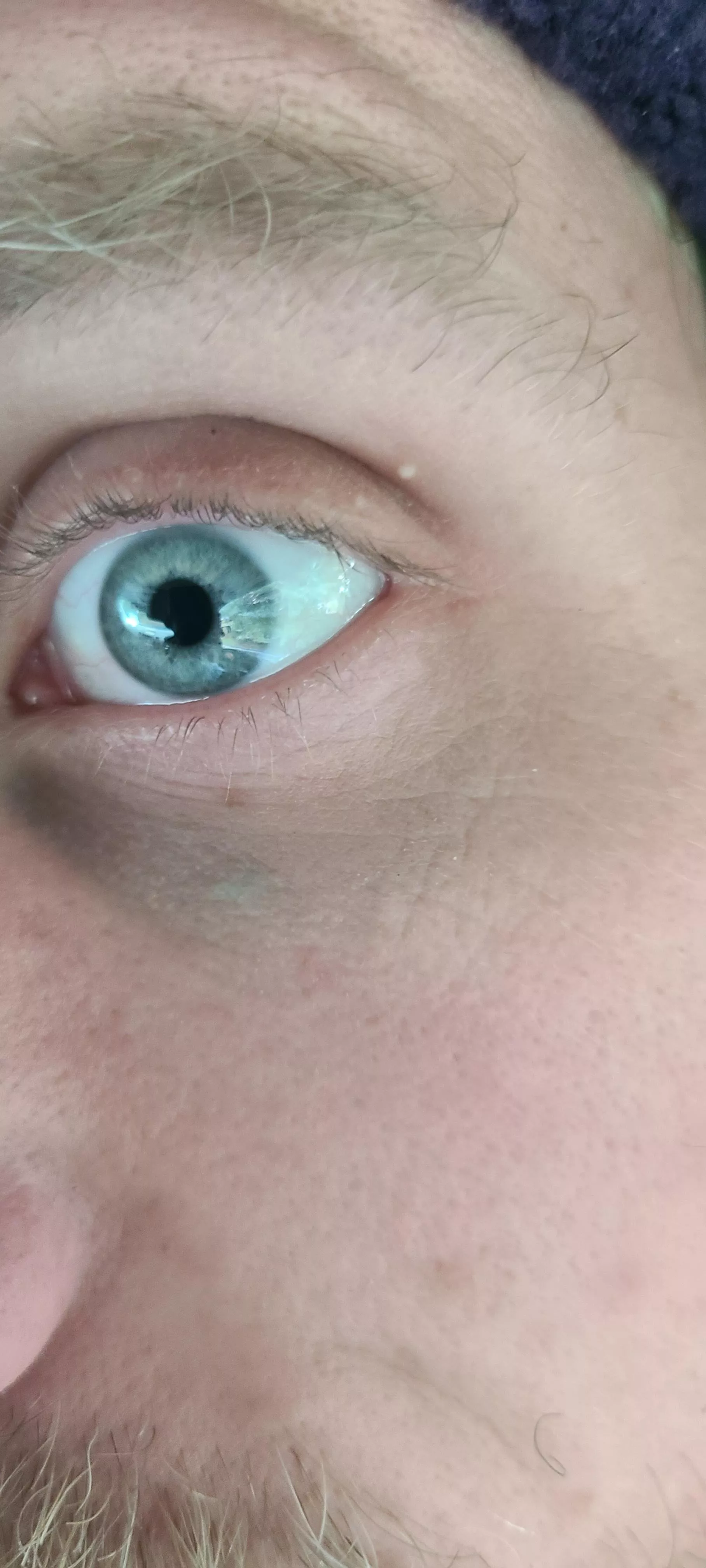 What are these things on my eyelids? They don't pop and aren't sore or anything. Had them for a year or so, maybe longer.