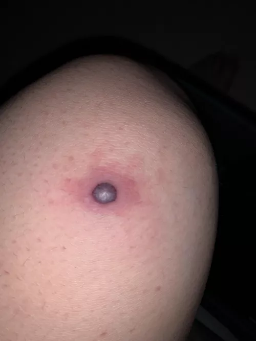 What is this? It’s like a blood filled pimple on my knee but I don’t know what could have caused it.