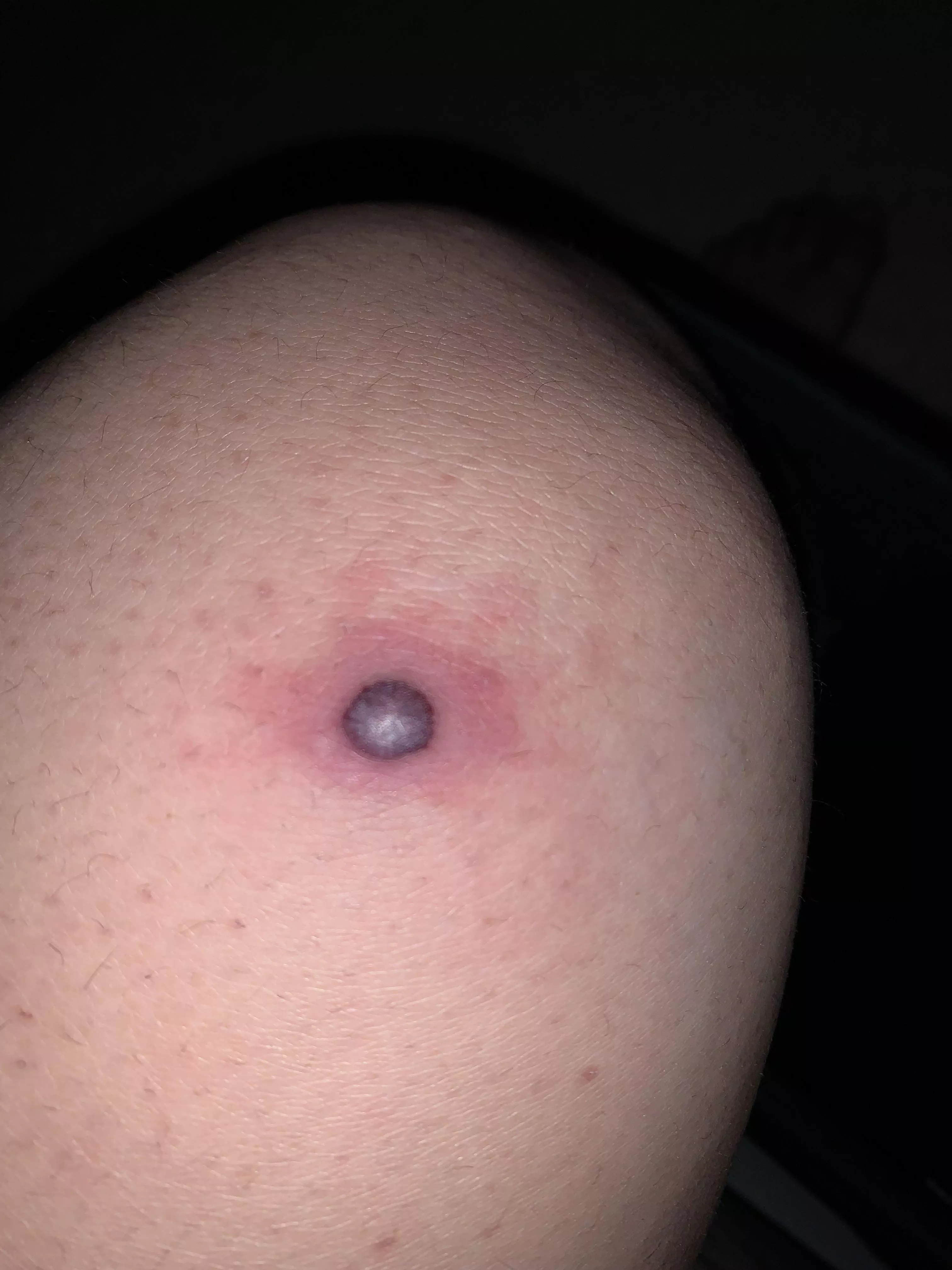 What is this? It’s like a blood filled pimple on my knee but I don’t know what could have caused it.