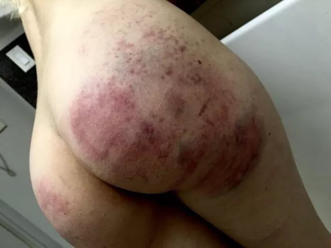 Who likes bruises? [F]