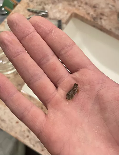 Woke up and I couldn’t hear, water irrigation got this out of my ear!