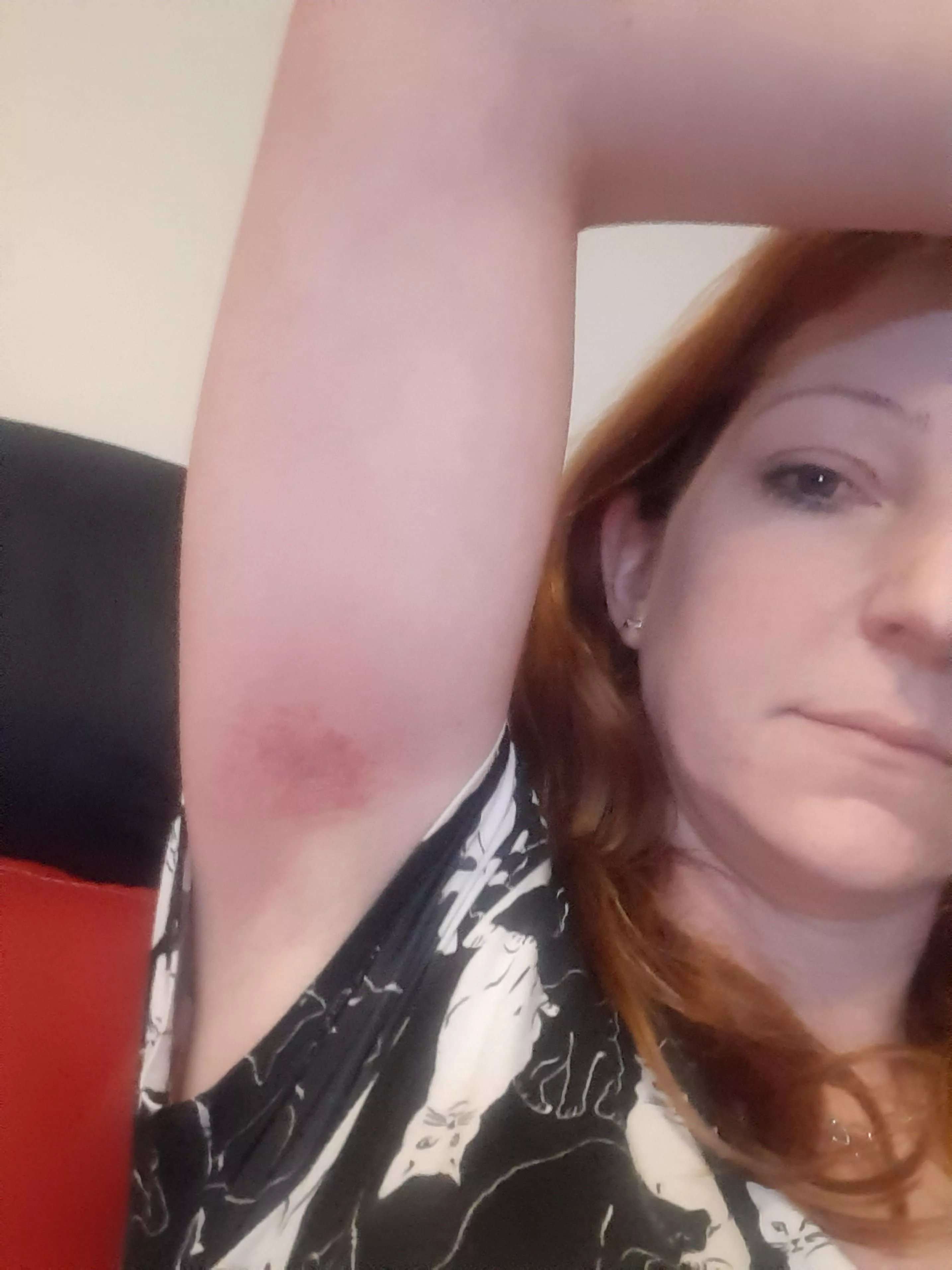 Yes, you can bruise an armpit Yes, you can bruise an armpit