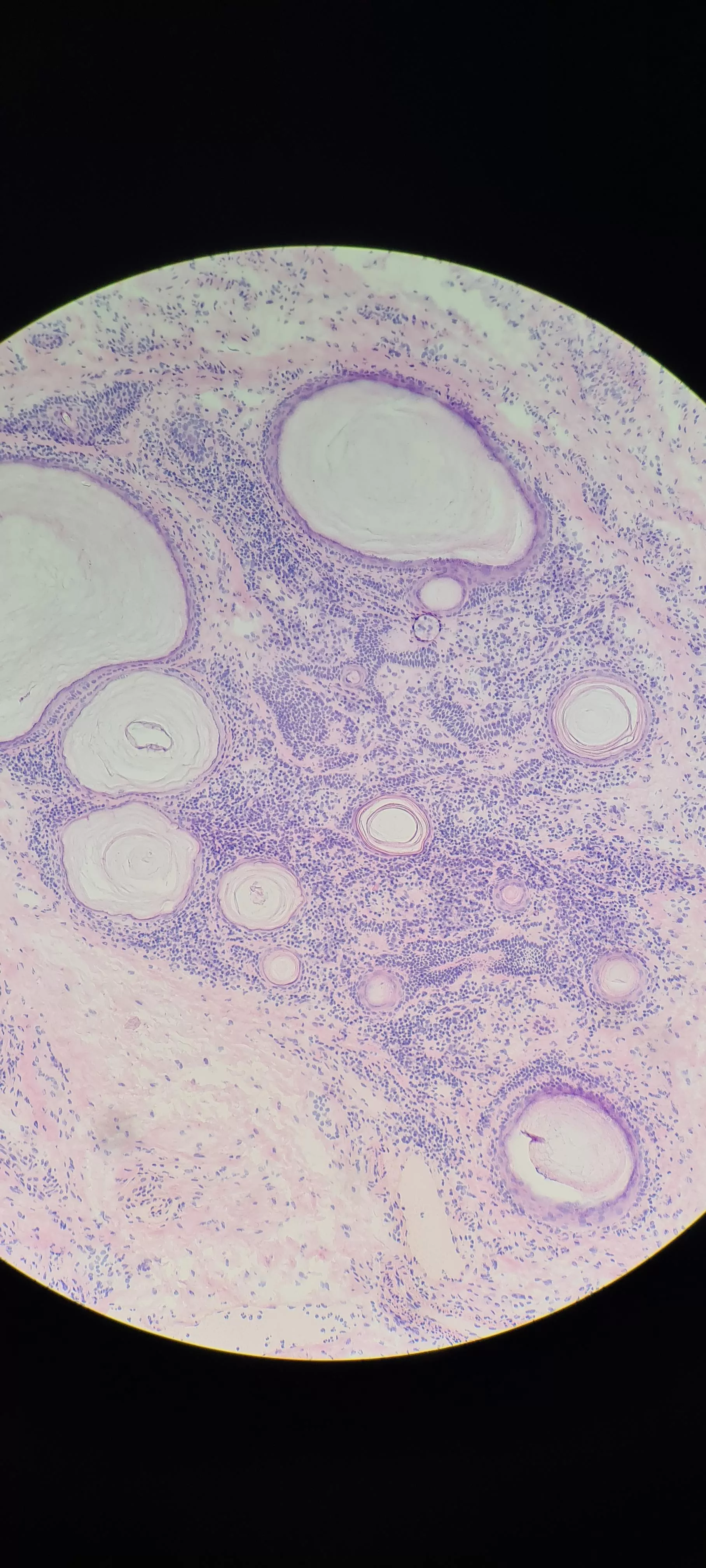 You guys seemed to like my previous histo images of cysts. Here is a particularly dense cystic structure in an eyelid. Thankfully cancer free.