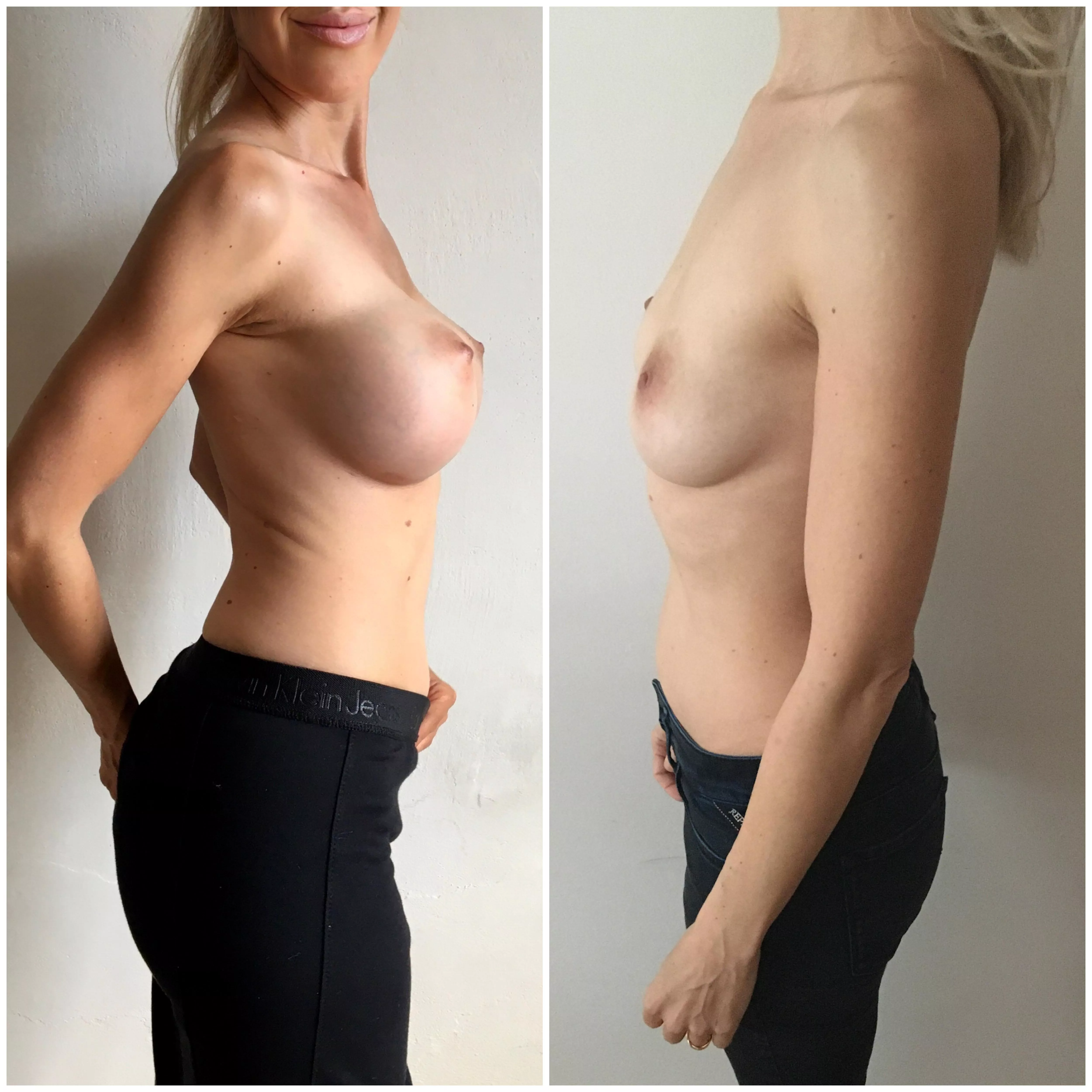 You have to understand - breast enlargement is for us women the same spiritual matter as if your penis were to go down and never up... :/ You have to understand - breast enlargement is for us women the same spiritual matter as if your penis were to go down and never up... :/