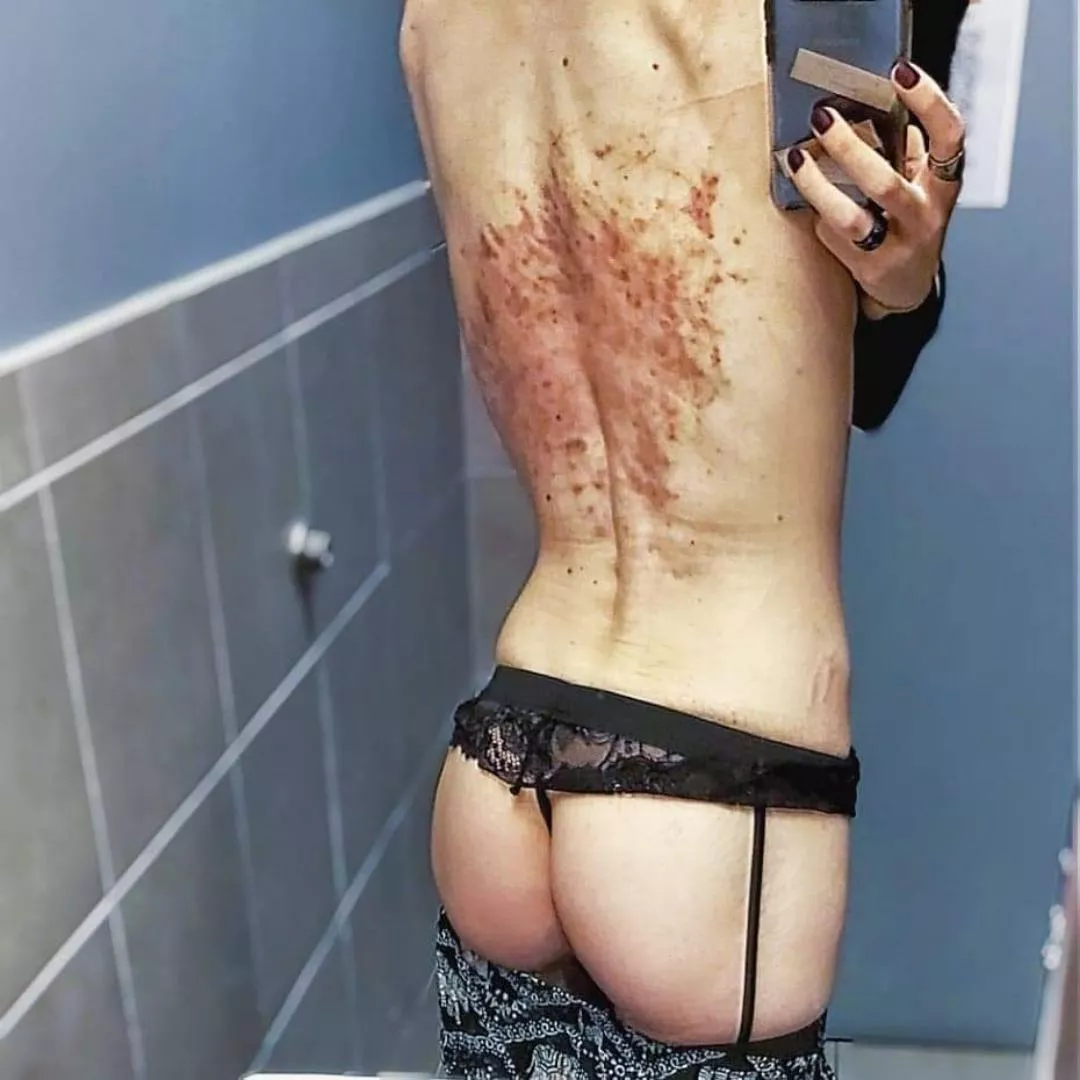 300 lashings and 24 hours later... it's still warm to the touch. sensitive and sore but looks much worse than it actually feels.