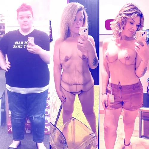 After losing 190lbs, my outside didn’t match all the hard work I have put in… it does now. Worth every penny and every inconvenience. Wouldn’t you agree?