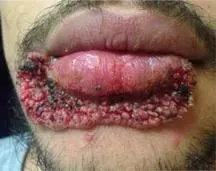 Always use clean tools! Credit to r/medicalgore, for some reason I couldn't xpost.