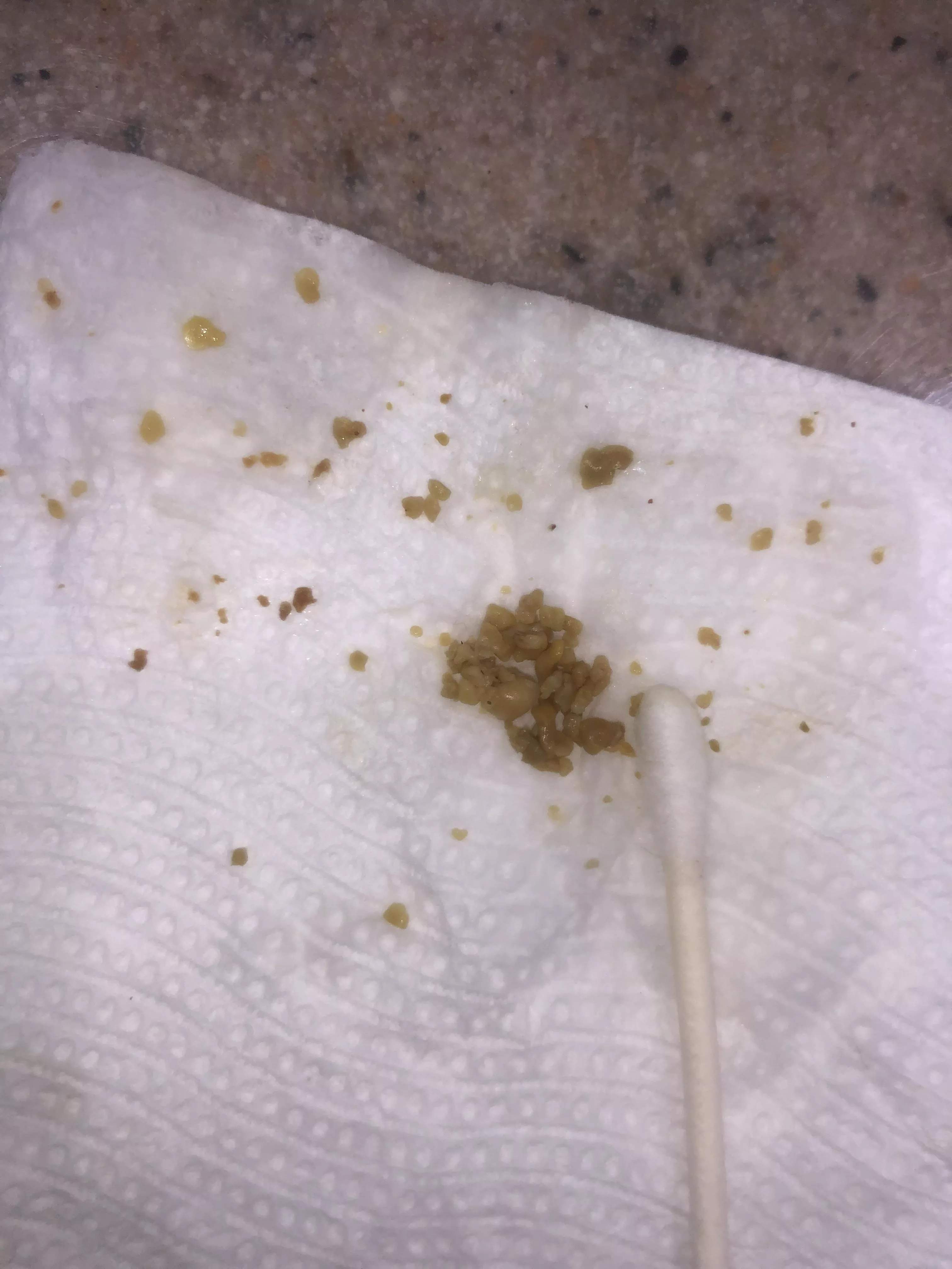 And the stones are still coming out 🤮