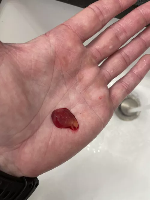 Blew this out of my nose this morning. Then epistaxis followed. Consistency of a fruit chew, but I could breathe so well!