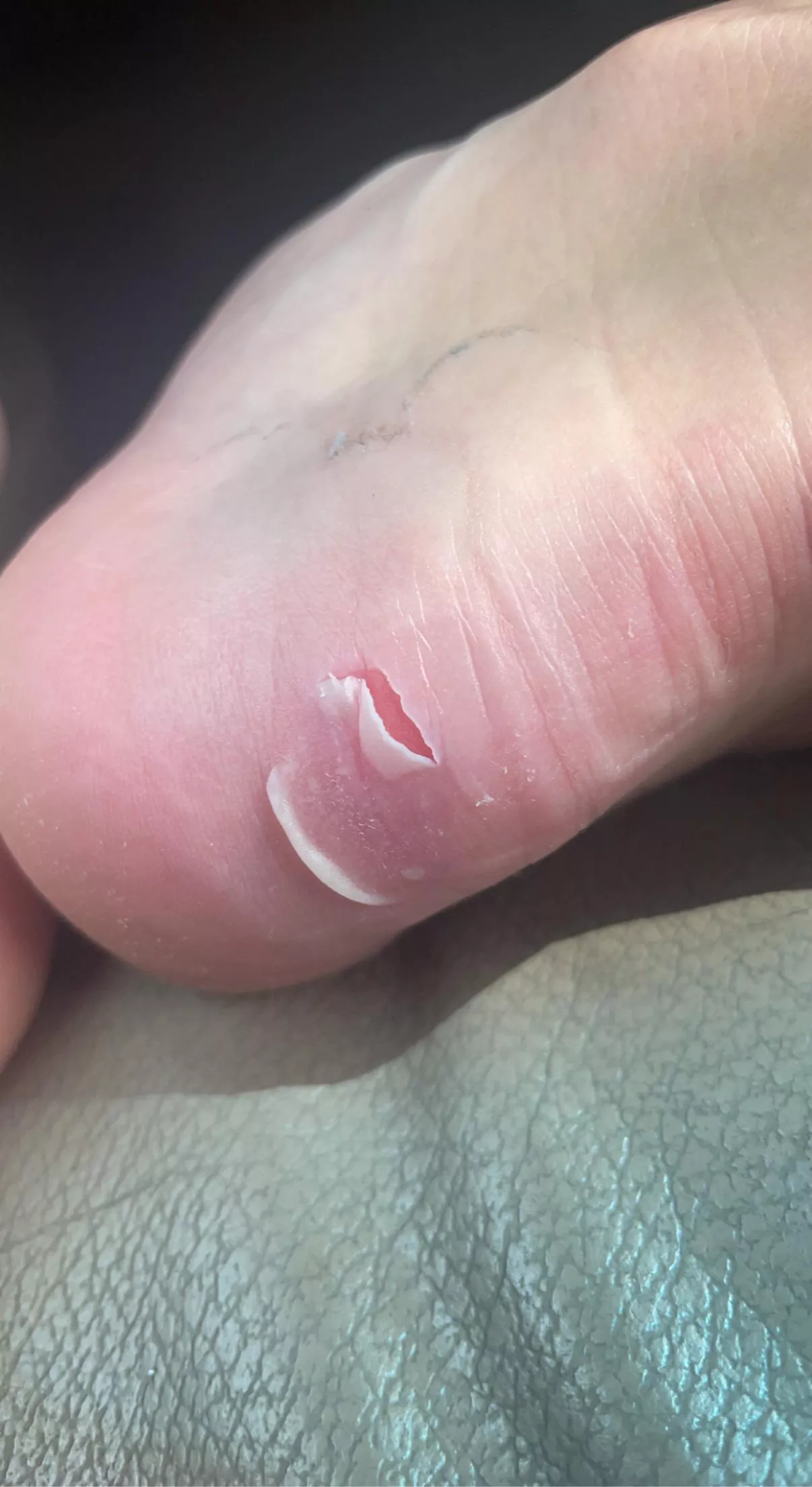 Blister I formed on my heel from steel toe boots. Felt it pop this morning.