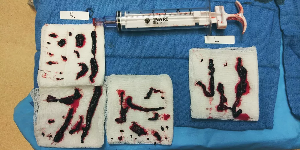 Blood clots removed from my lungs via suction