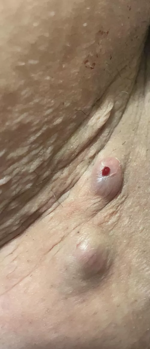 Boils on inner thigh/ butt area that I always get. They typically drain by themselves, super painful tho :/