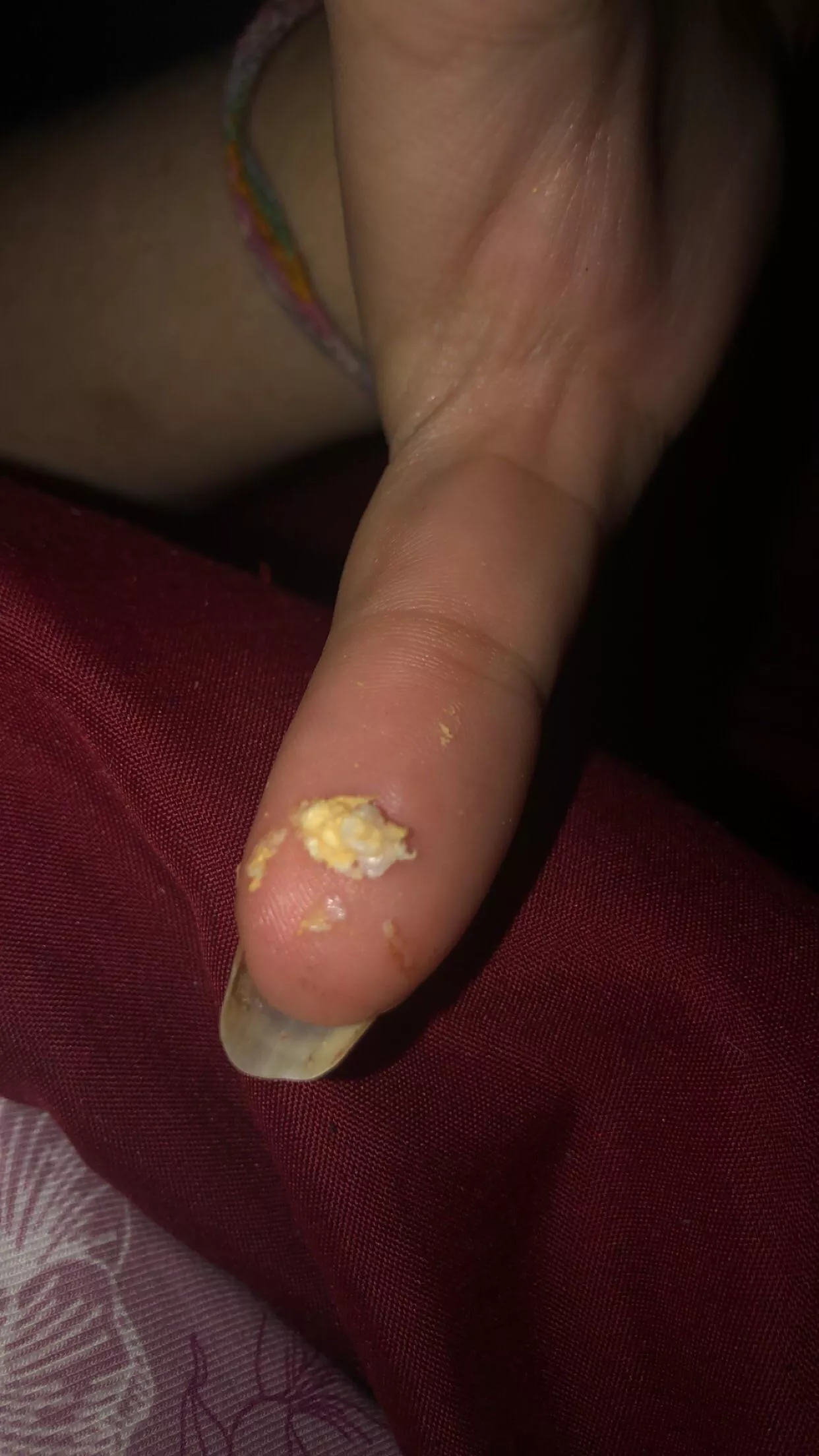 Cyst? gunk. had a small bump on the hood of my clitoris. didn’t know it was a cyst until it was hurting this morning. sadly no video, but some gunk!