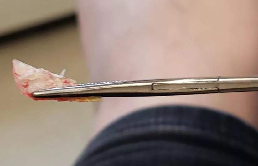 Finally got my ingrown toenail removed by Dr.!