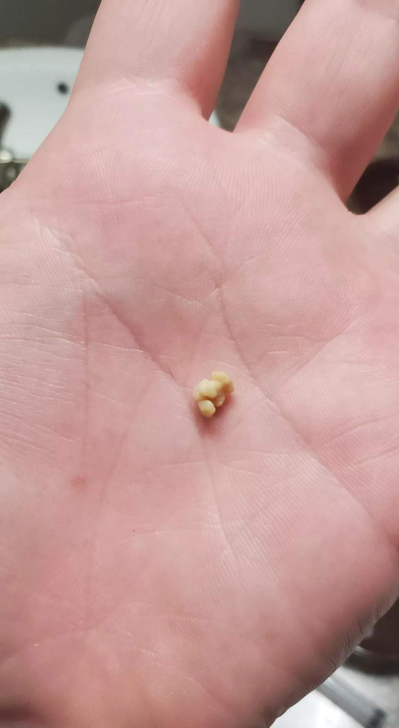 Finally managed to pop out this absolute unit of a tonsil stone today! Being freed of it is a beautiful feeling.