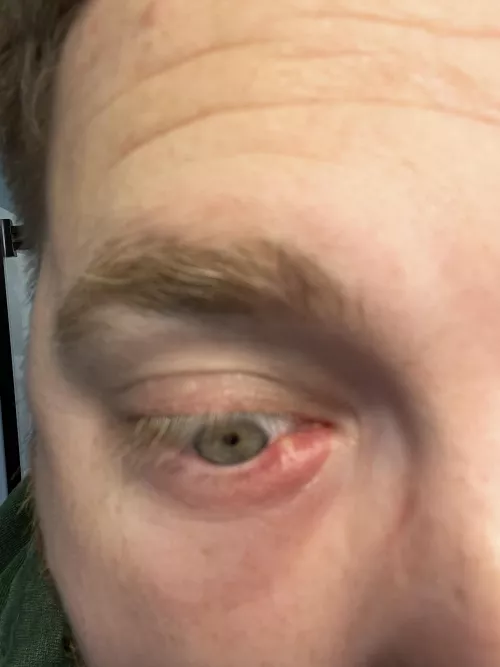 Forbidden Pop, been using a hot compress, hope this pops soon…