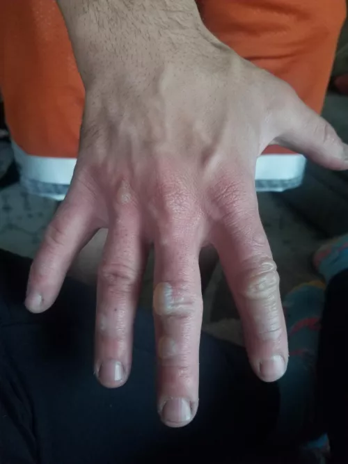 Forbidden pops on my fiance's hand after getting a little too friendly with some fire 😬