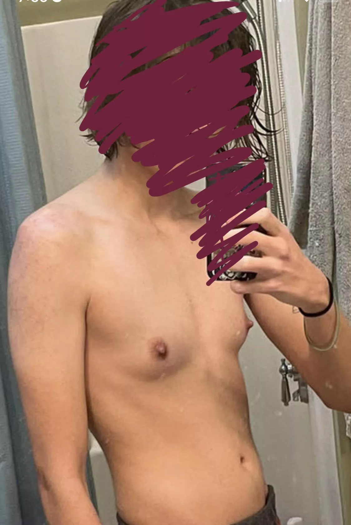 FtM / 19 / 115lbs / 5’6… acceptance of my body pre op is hard but i’m grateful for making strides to feel better