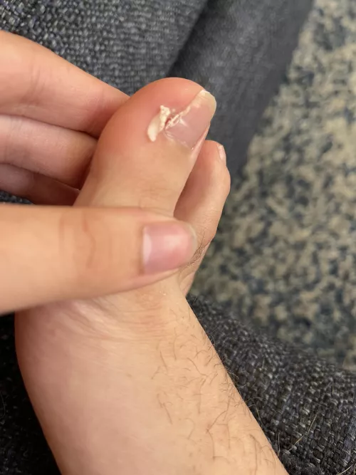 Got ingrown removed a few months ago. Think they missed a piece and I pulled it out.