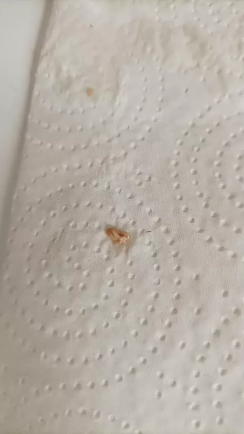Had a white head on my tonsil, gave it a push and this came out. Y'all weren't lying when you said they smelled lol