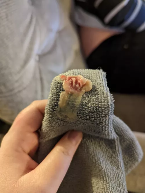 Had tonsilitis. This came out of my mouth. Dr checked and says half of my tonsil is missing and there's a massive hole where flesh should be. Anyone had this happen before? Dr thinks the tissue got infected and died. Not technically anything popping!