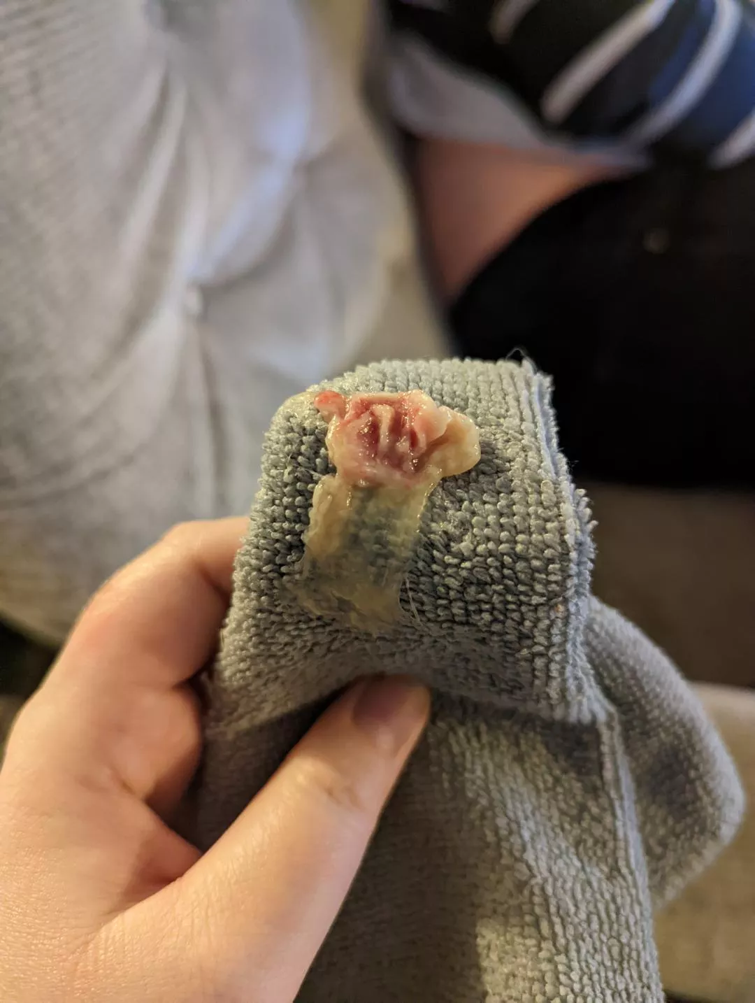 Had tonsilitis. This came out of my mouth. Dr checked and says half of my tonsil is missing and there's a massive hole where flesh should be. Anyone had this happen before? Dr thinks the tissue got infected and died. Not technically anything popping!