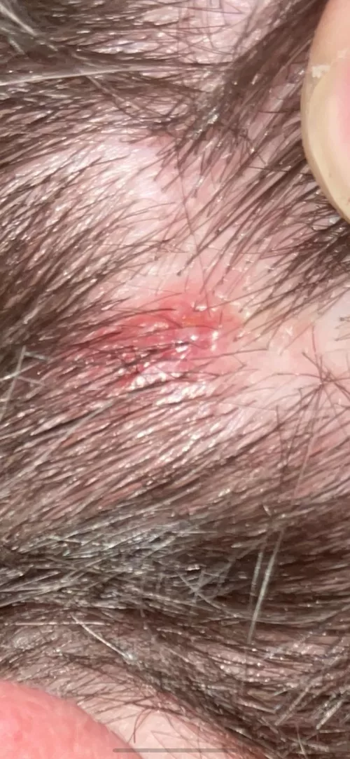 Hair line, anyone know if it’s an ingrown hair or a pimple?