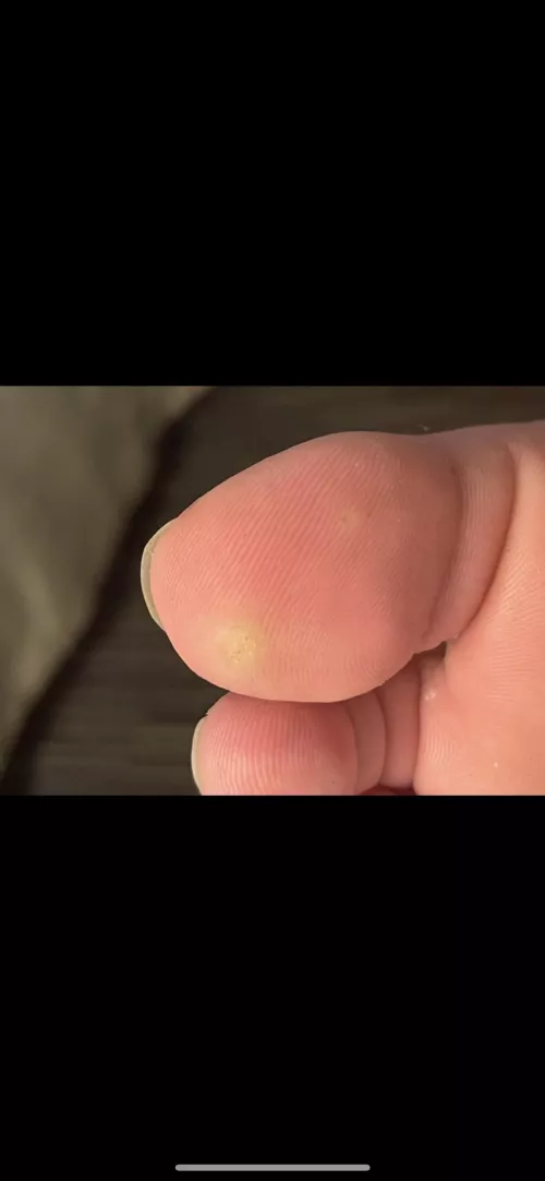 I got this pump a month ago on my toe and it hurts like hell does anyone know what this might be ? I’m reading comments about amputation and I’m like fuckk