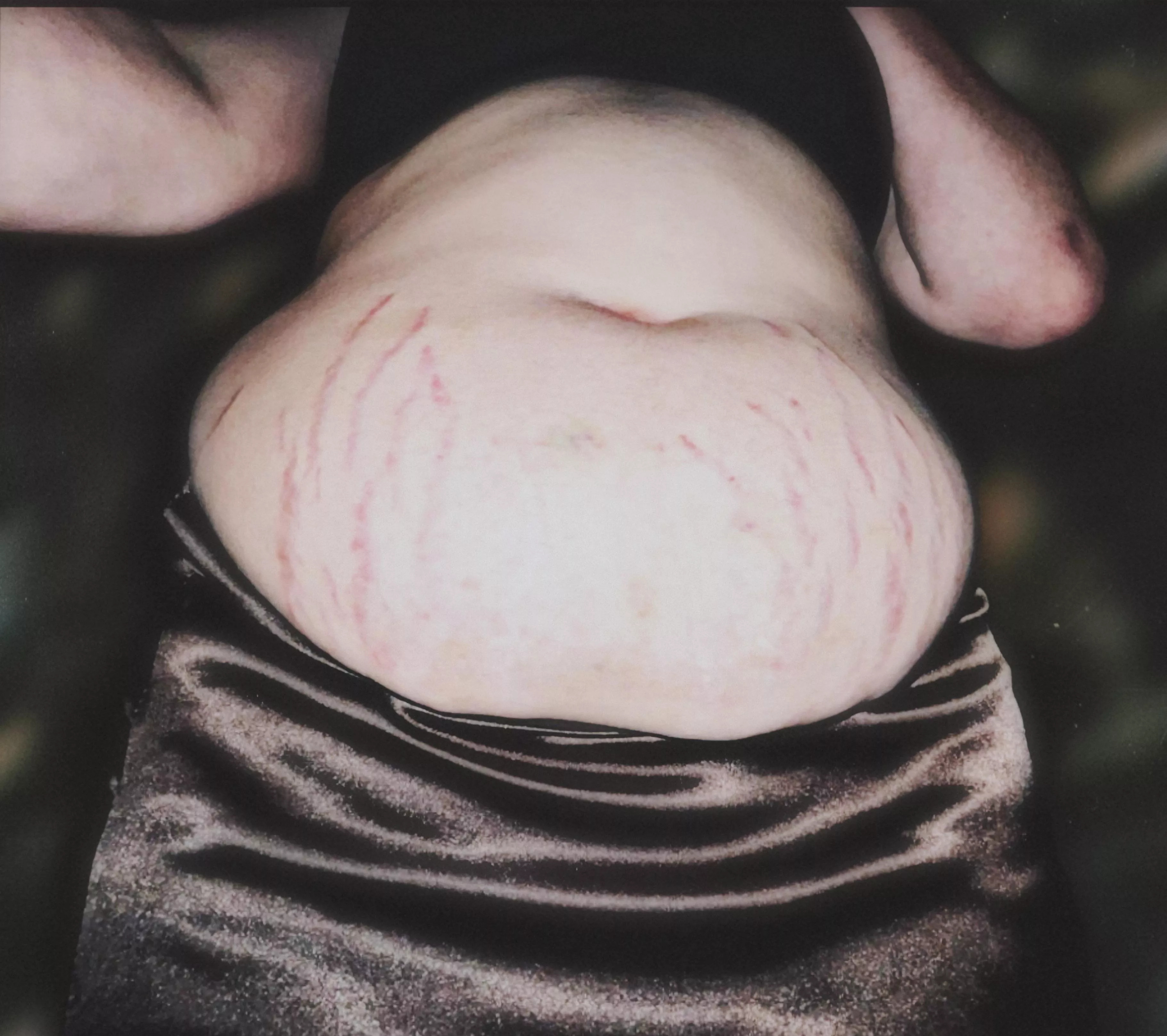 i haven't gained weight THAT quickly, have i? surely stretch marks like this are just from a little water weight...