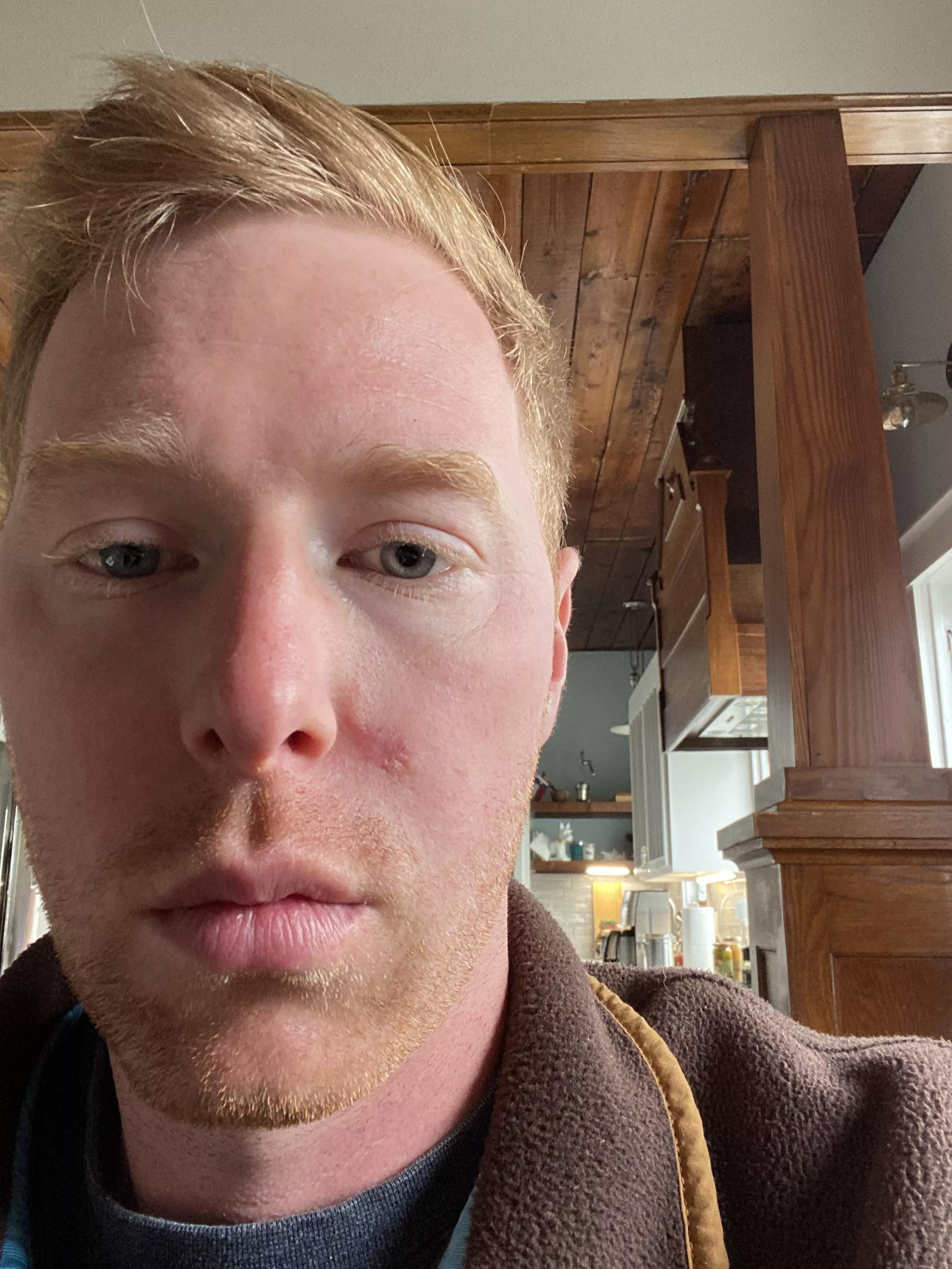 I know it’s small but the scar from my Mohs surgery is really making me self-conscious.