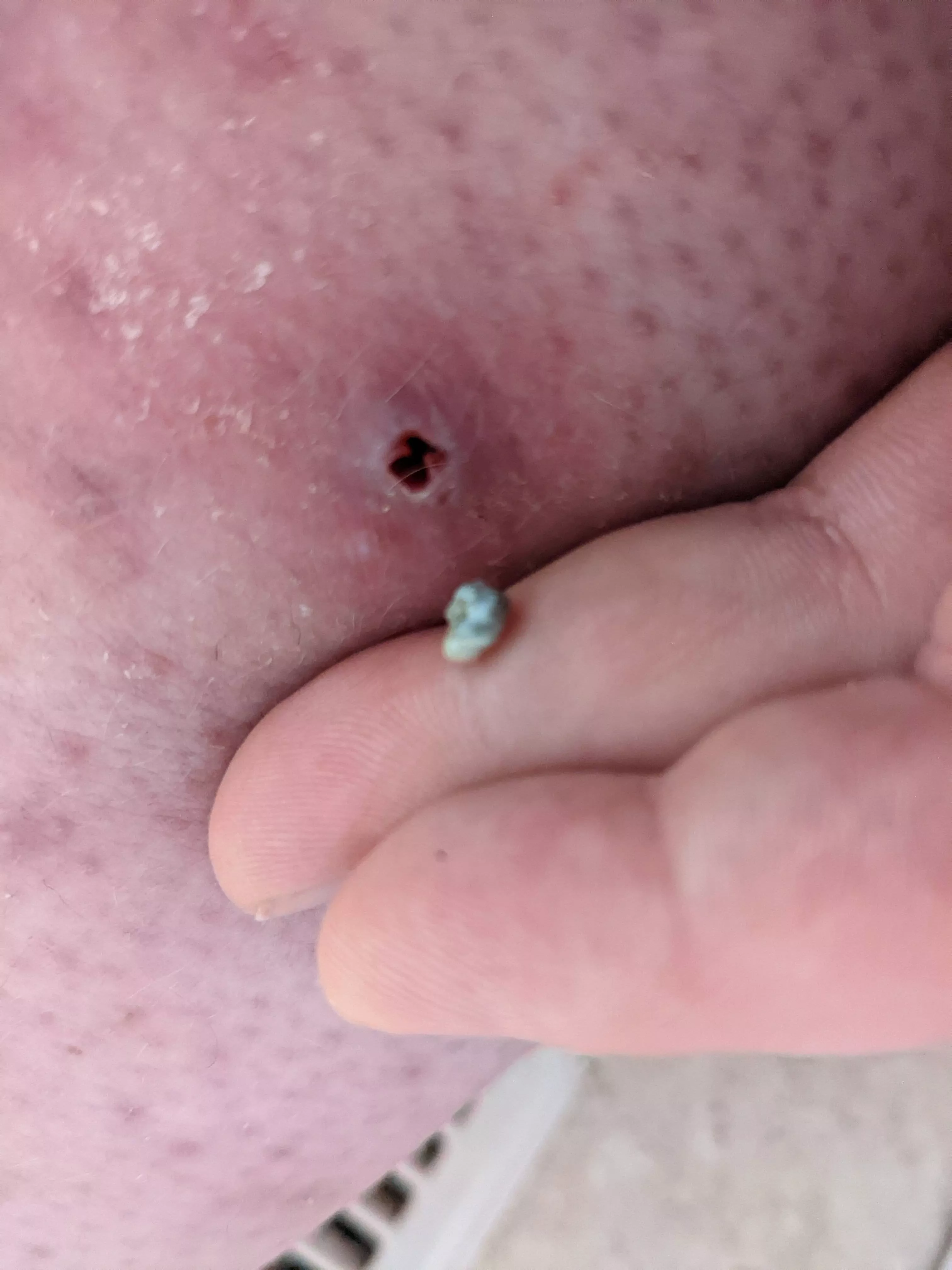 I Tweezed Something From my Leg!