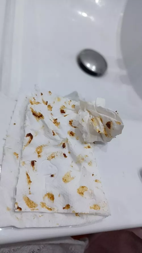 Insane earwax buildup. No idea why!