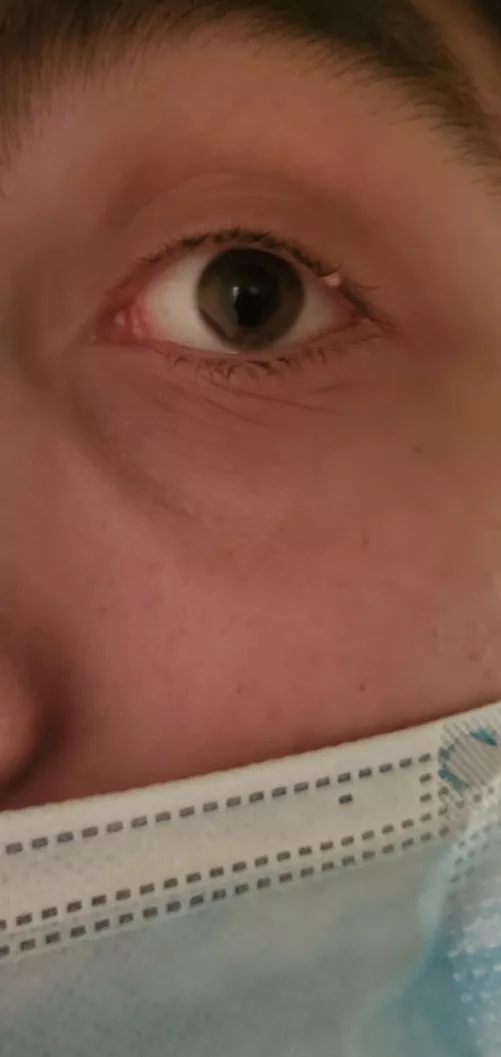 is this a stye? I've had it for 3 weeks now and it's never been painful and it never grew more than this size.