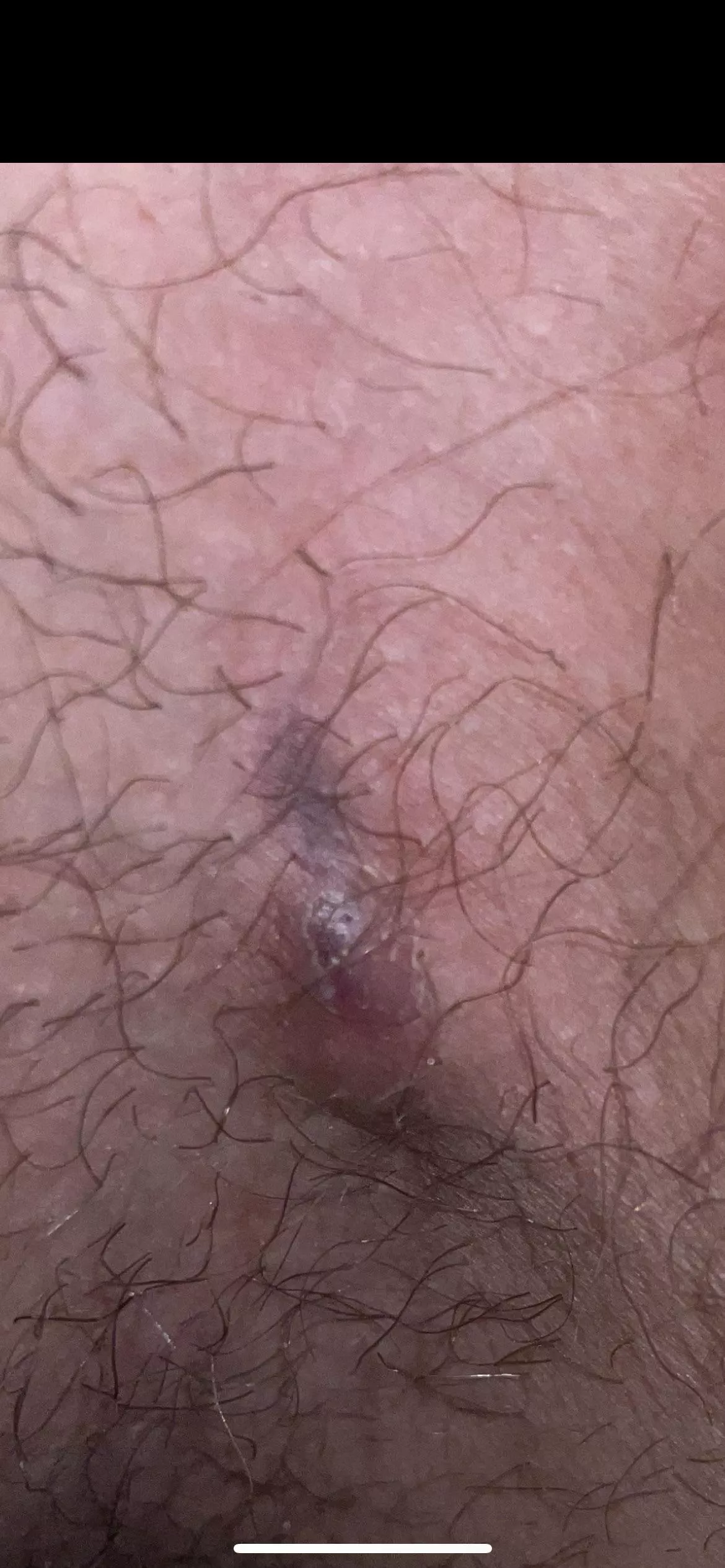 Is this ingrown hair or something else, its right next to ny balls. It like a dark underskin line that is soft to touch but it cant be popped. Its also like a little bump.