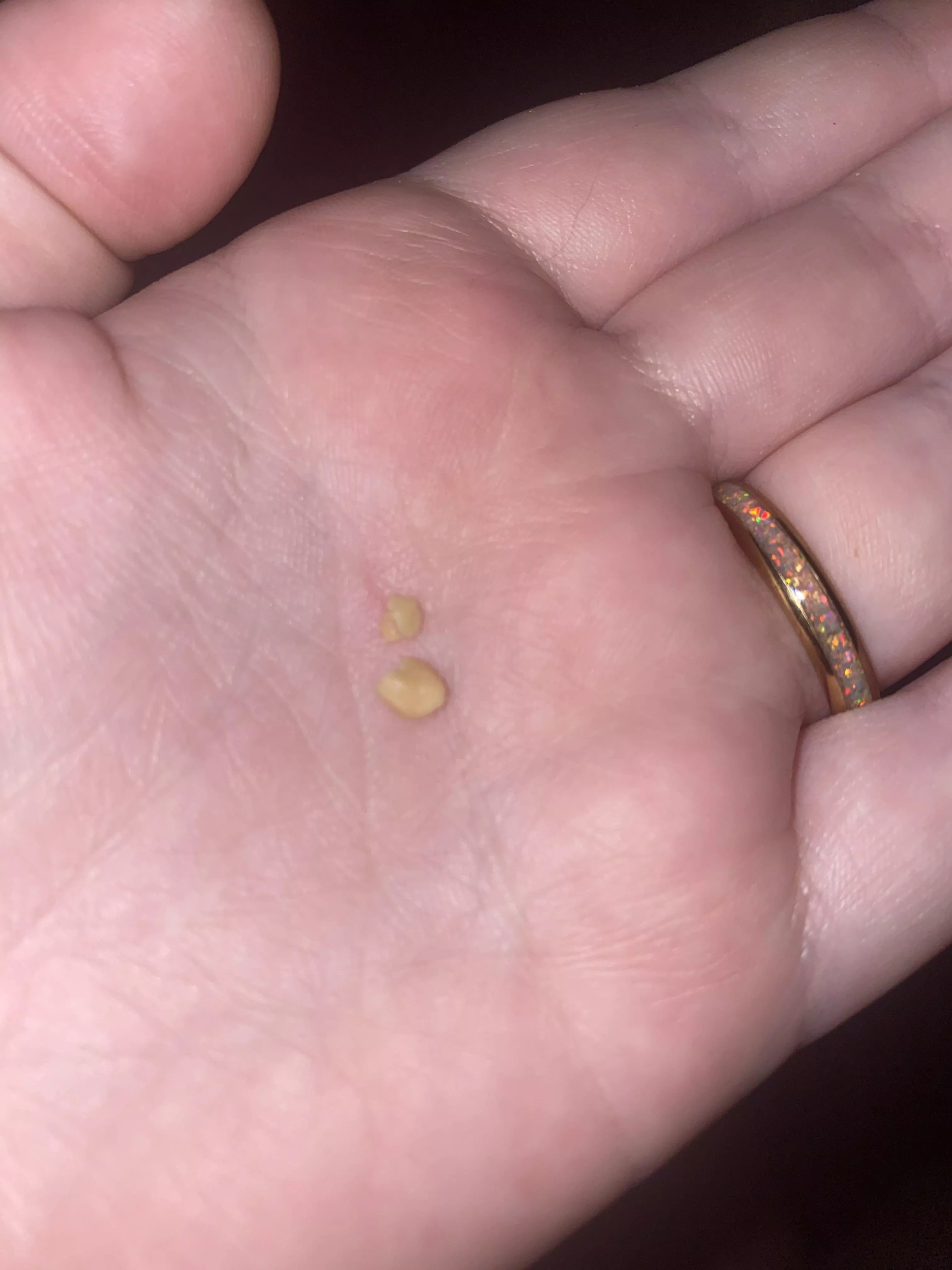 Just coughed up my first tonsil stone this is so weird