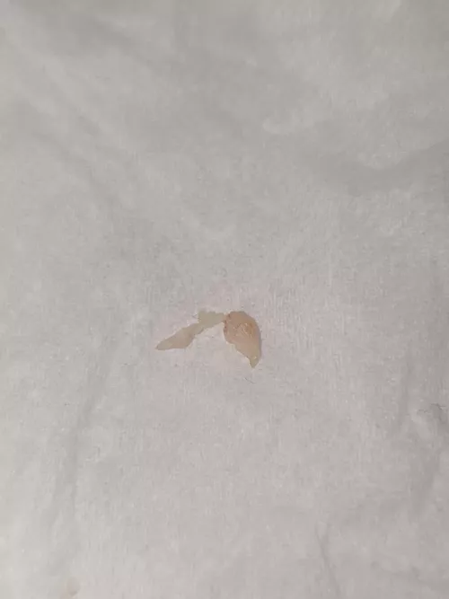 Just popped this on my chest after it botherd me for weeks now. Its quite hard tissue, what do you think it is?