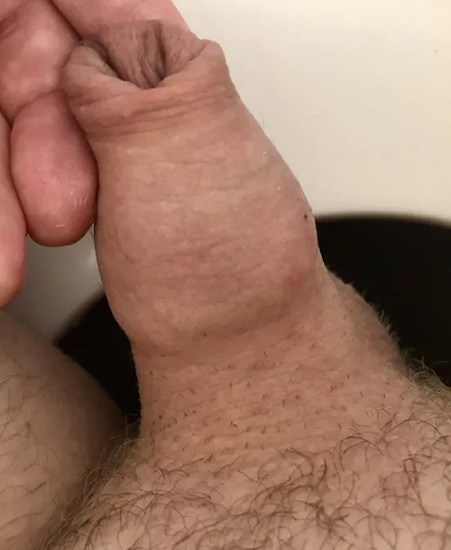 Making great progress with foreskin restoration. 3.5 years next month but very much worth it.