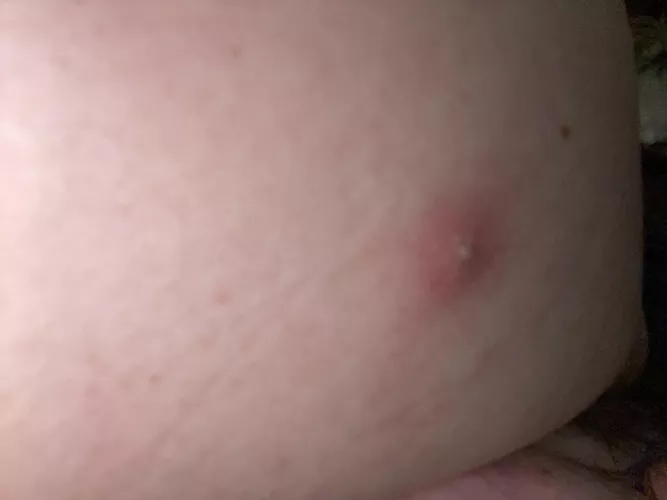 Massive bump on my back. Painful and it needs to go!