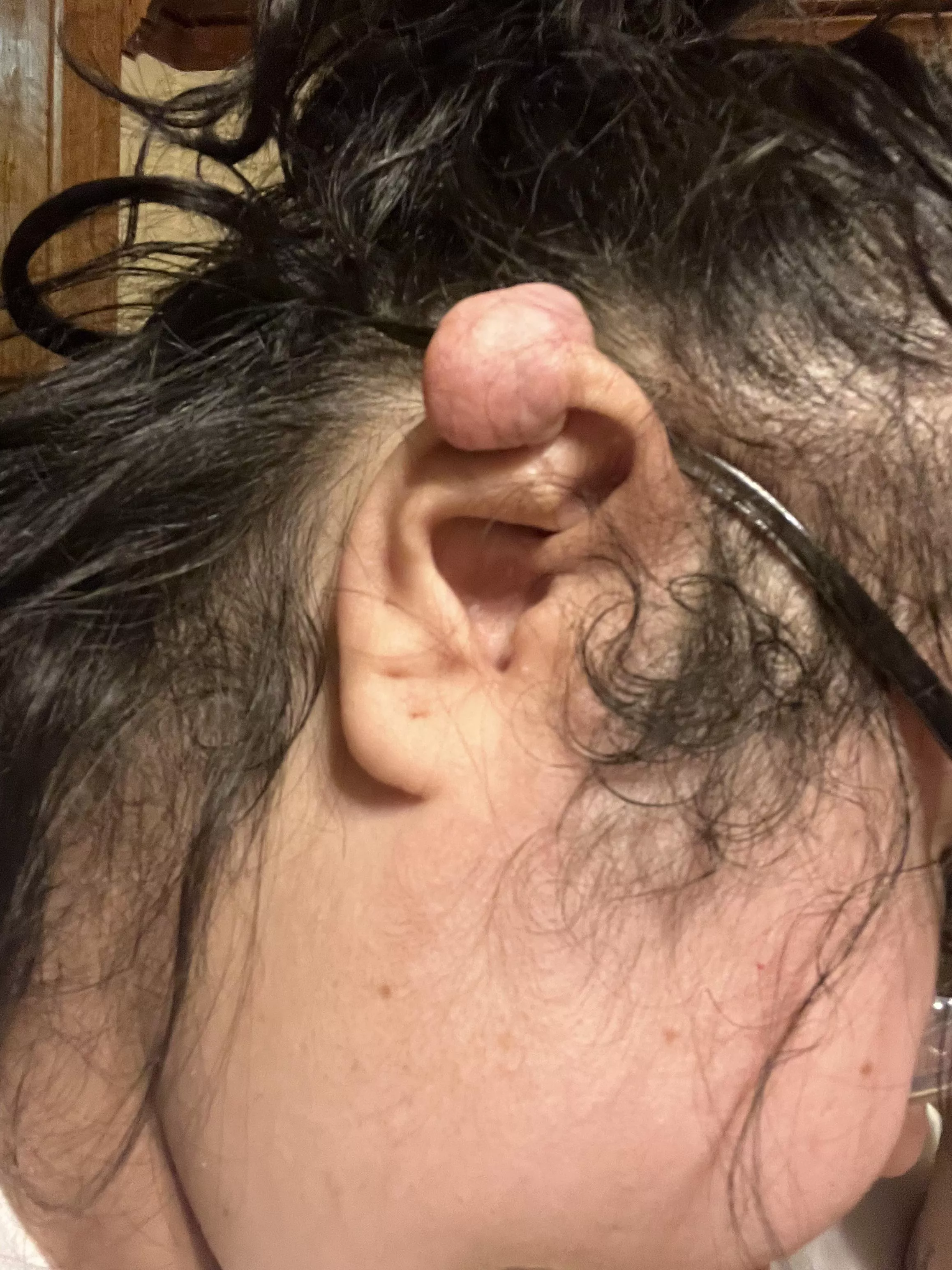 Meet the keloid that refuses to leave!! I’ve had my ear operated on 3 different times to get rid of it. The last time I got it removed the surgeon said this was the last time he’d do it because I obviously wasn’t taking care of my self.