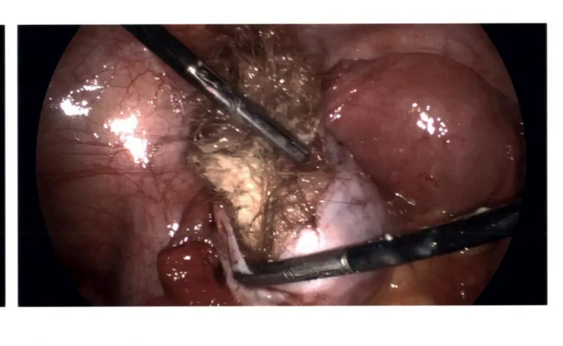 My hairy dermoid cyst they removed from my ovary. They had to pop it during surgery to get it out.